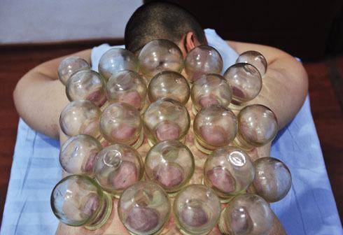 cupping is gross